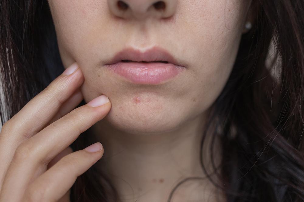AviClearTM a Safer, More Effective Acne Alternative to Accutane